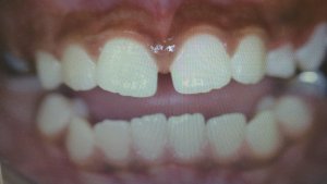 Dental Bonding - Before and after
