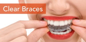 Clear braces