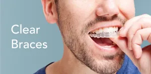 Clear braces