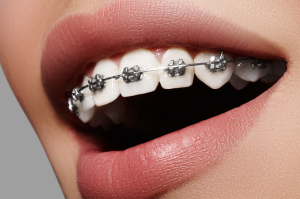 Silver braces