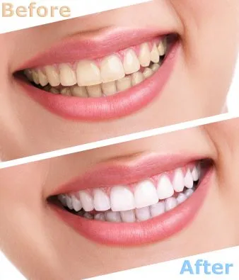 Teeth whitening - Before and after