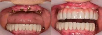 Dental implants, Before & After