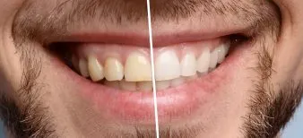 Teeth whitening - Before and after