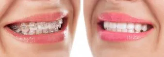 Clear Braces - Before and after