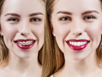 Silver Braces - Before and after